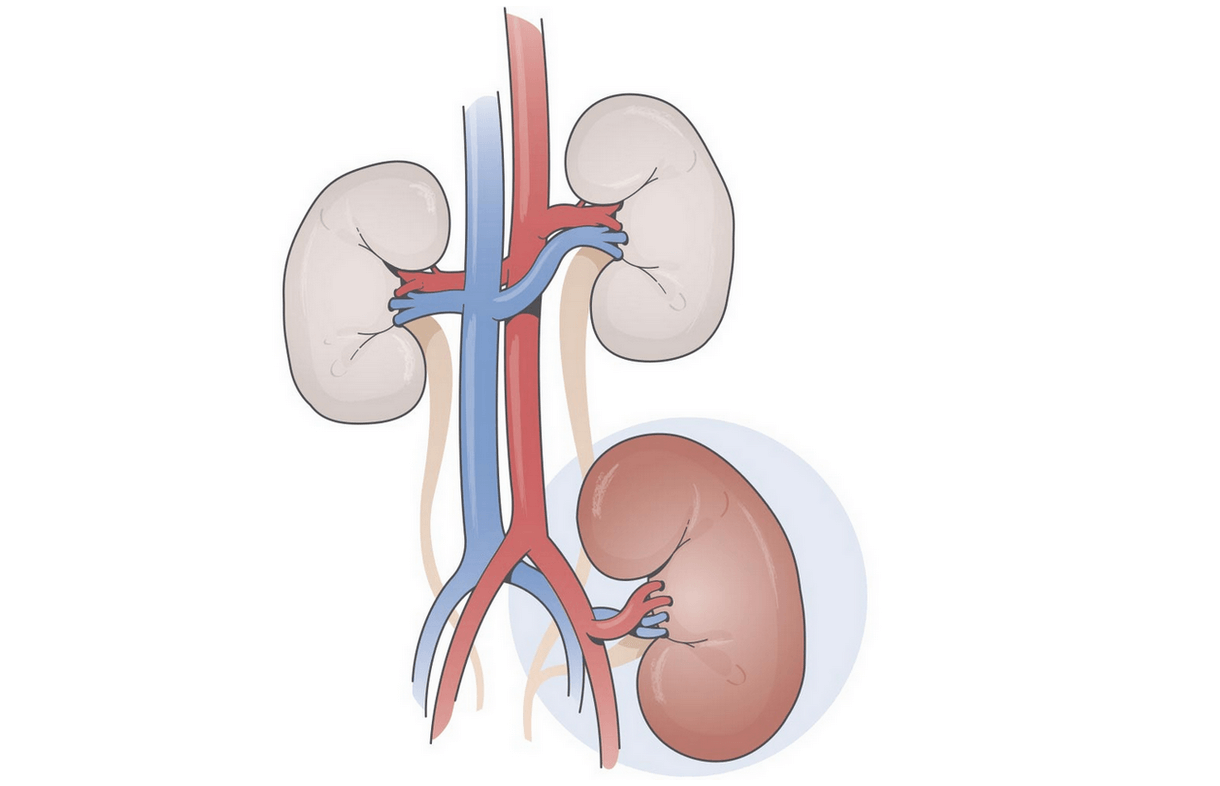 Opções De Tratamento Para Doença Renal Crónica Drc Fresenius Medical Care 5406